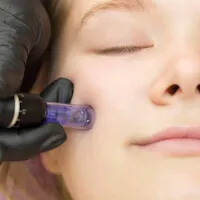 Kosmetikstudio Schönheitssalon Microneedling in Trebur