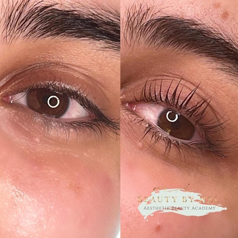 browlifting