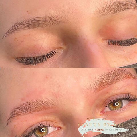 browlifting