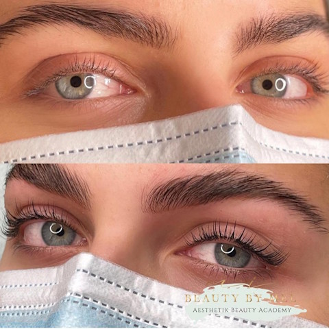 browlifting