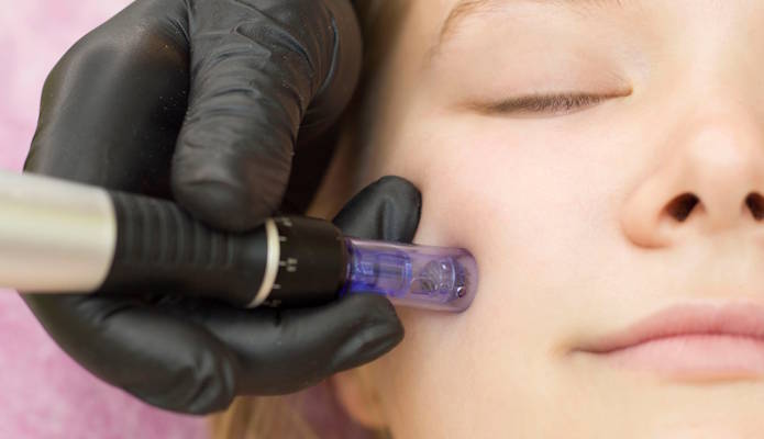 Microneedling Kosmetikstudio in Trebur 